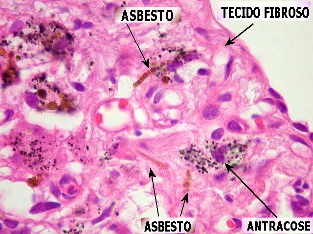 asbestose_patologia.jpg